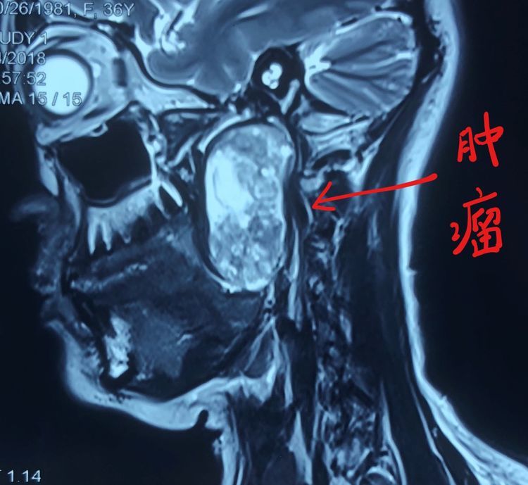 使用個性化切口完成一例腮腺顱底咽旁巨大腫瘤病例 - 好大夫在線