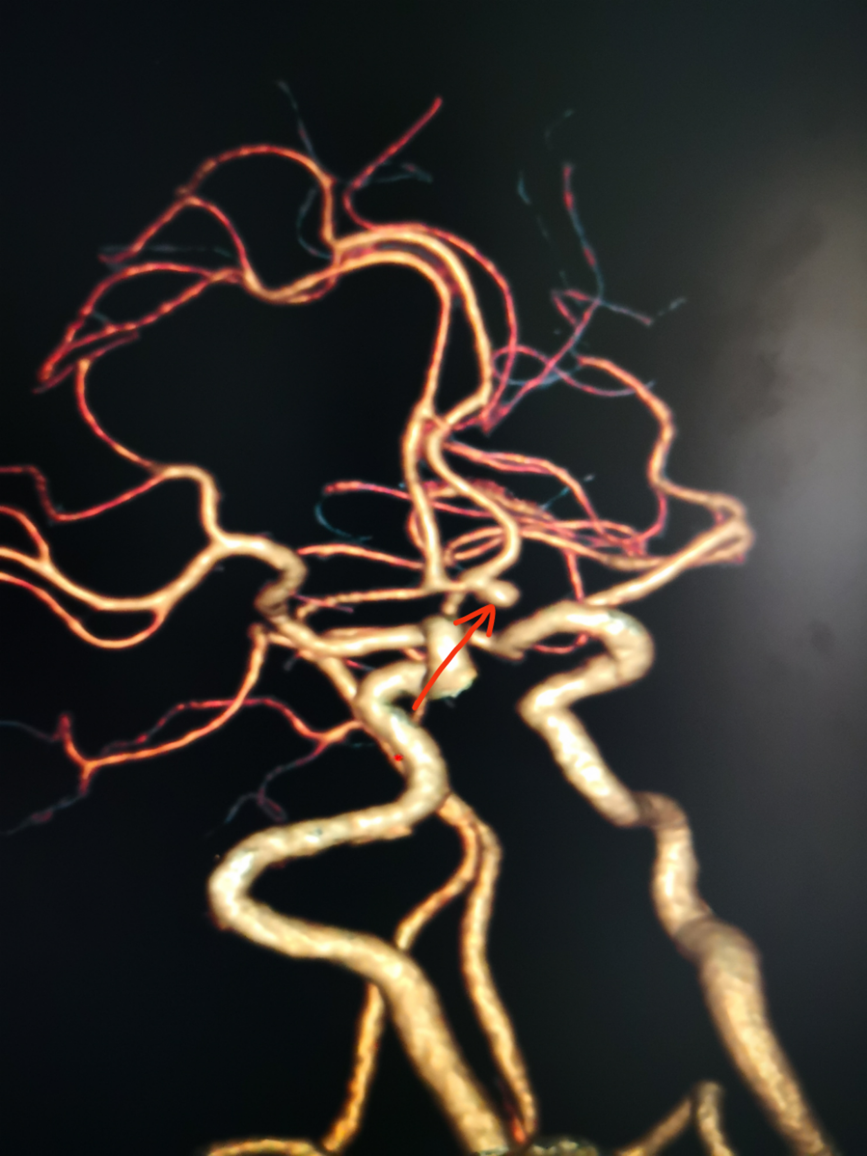 前交通动脉瘤手术一例