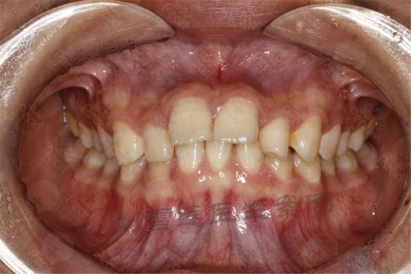 牙齒矯正病例分析——牙列不齊,深覆合深覆蓋,畸形過小牙