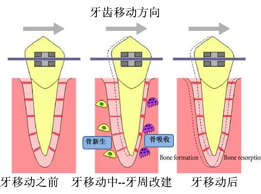 所谓颌骨的可塑性,指的是在正畸治疗过程中,机械力刺激通过牙齿传递到