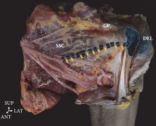 肩关节外侧疼痛的原因之一:三角肌下滑囊炎. - 好大夫在线