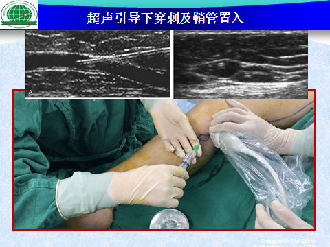 射频消融治疗下肢静脉曲张方法的一点改良 