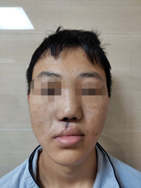 唇裂术后鼻唇畸形(鼻中隔发育不良)整复 肋软骨移植 - 好大夫在线
