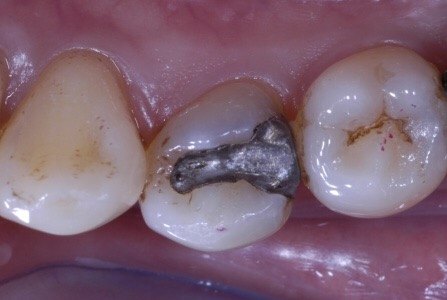 我是如何处理食物嵌塞