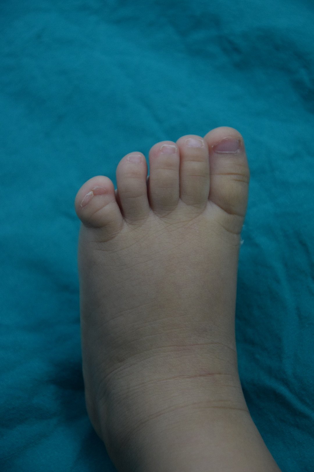 多趾畸形 - 好大夫在线