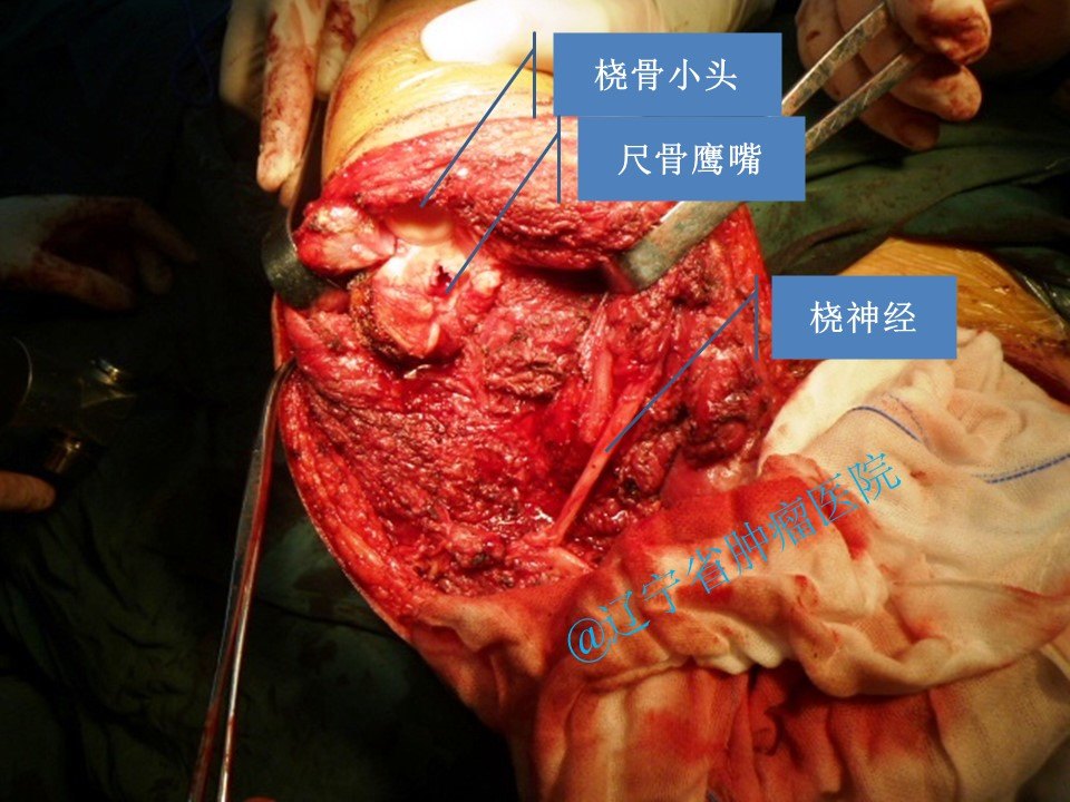 肱骨恶性肿瘤切除全肱骨假体置换术