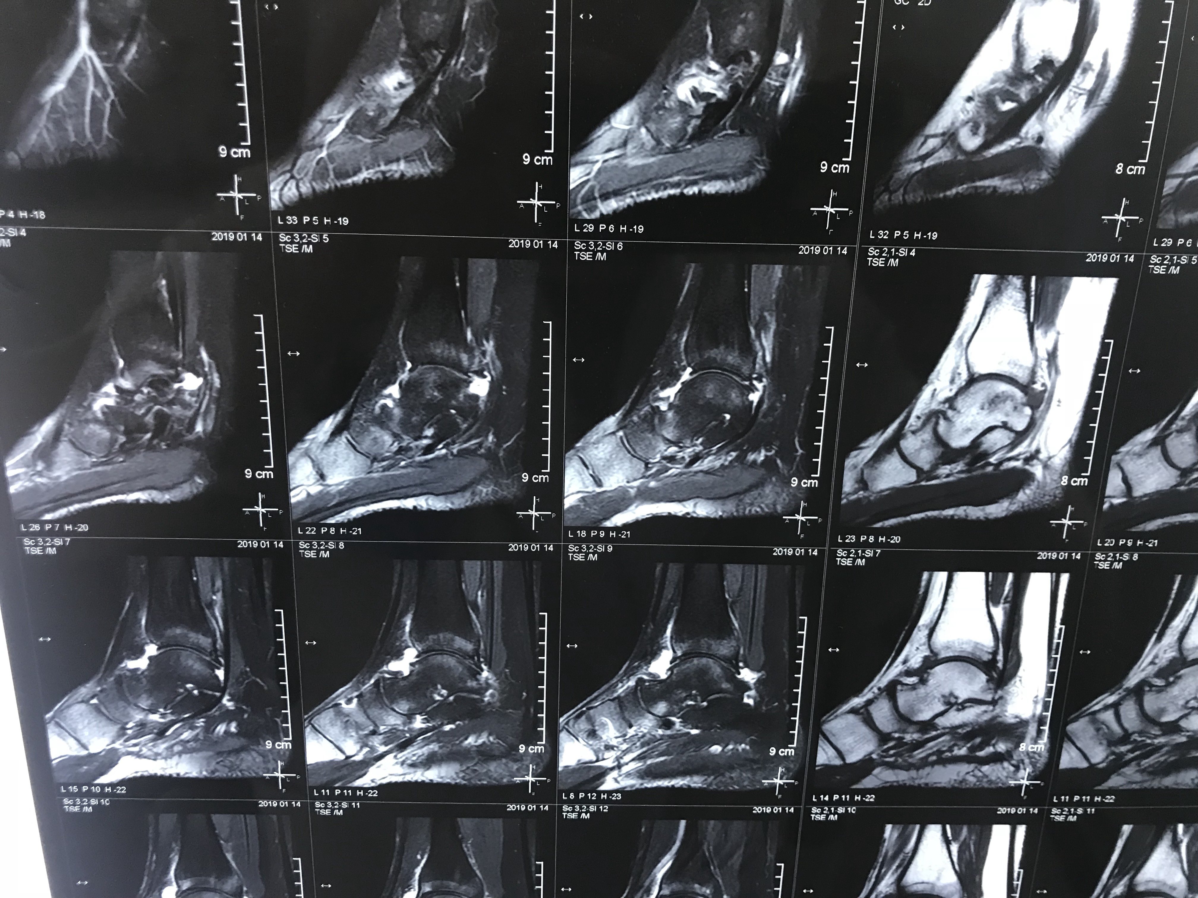 男患者痛风踝关节活动严重受限,行关节镜下探查清理术后功能改善