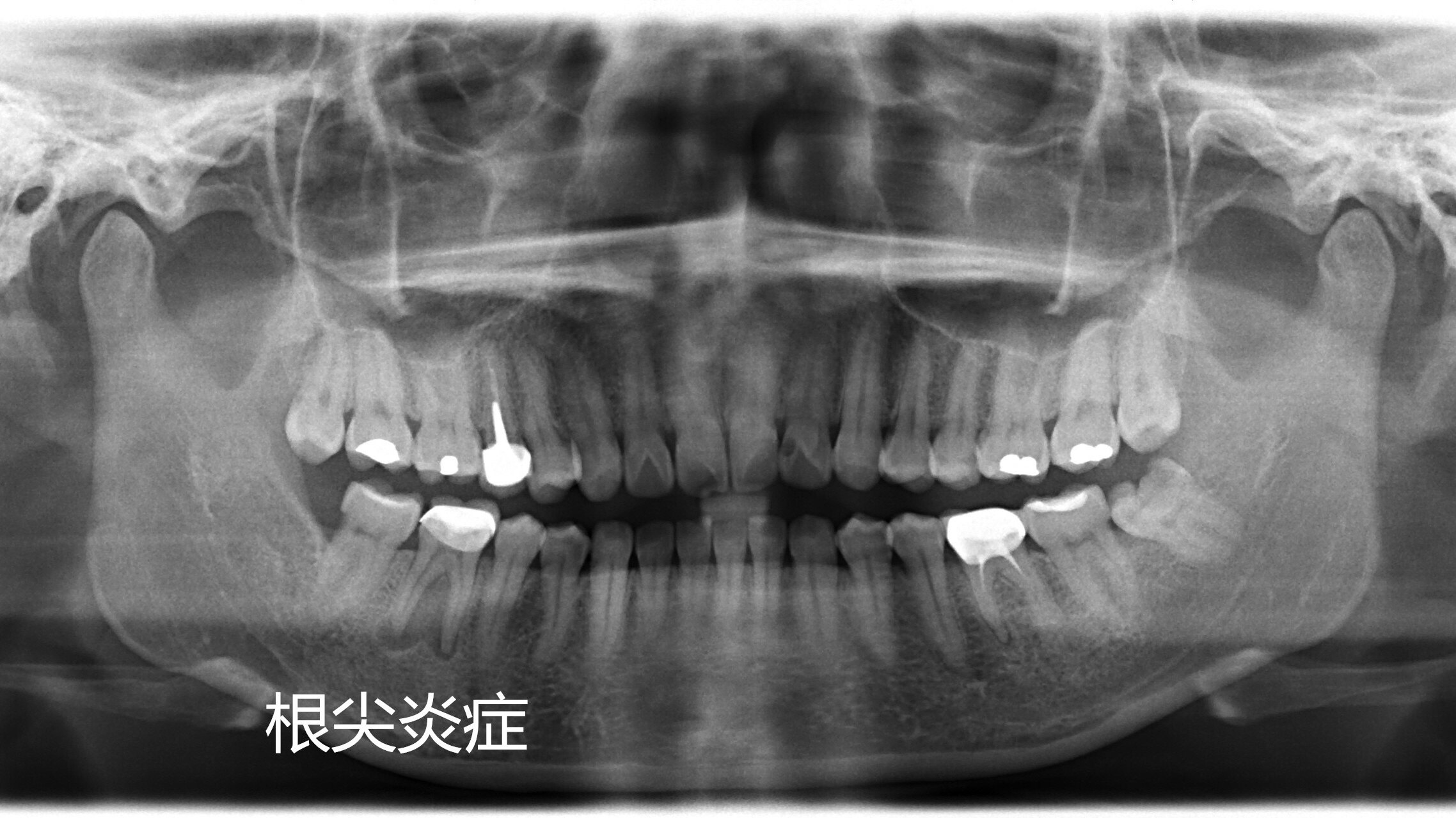 图1:x线示右下6根尖慢性炎,骨质破坏影像,为冠修复.