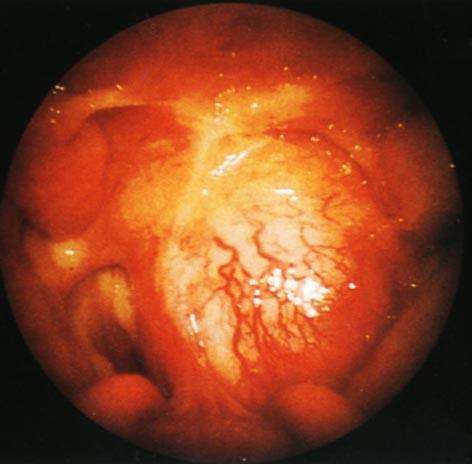 上皮内瘤变什么意思 xIYBAFw9fwiABgNJAABObCzpBMw820.jpg?_ms_=cb29