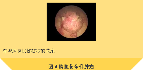 男人膀胱肿瘤图片图片
