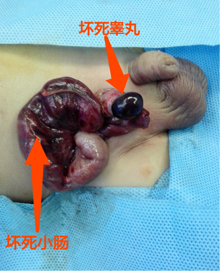 儿童睾丸疝气症状图片图片