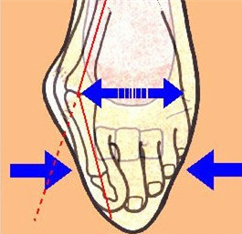 拇外翻就诊前须知_拇外翻_疾病介绍_治疗方法_介绍_治疗方式 - 好大夫