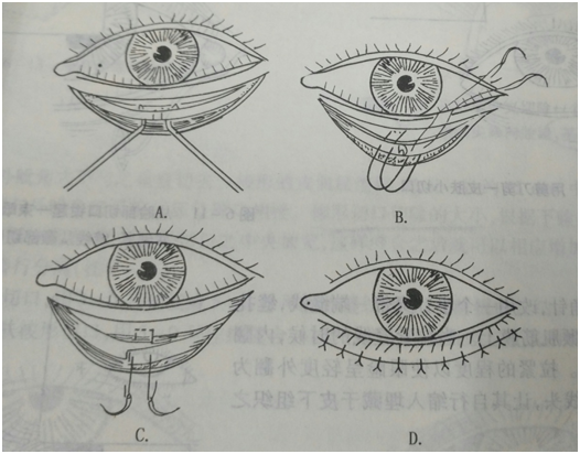 為什麼瞼內翻手術後又復發了手術方式沒選對