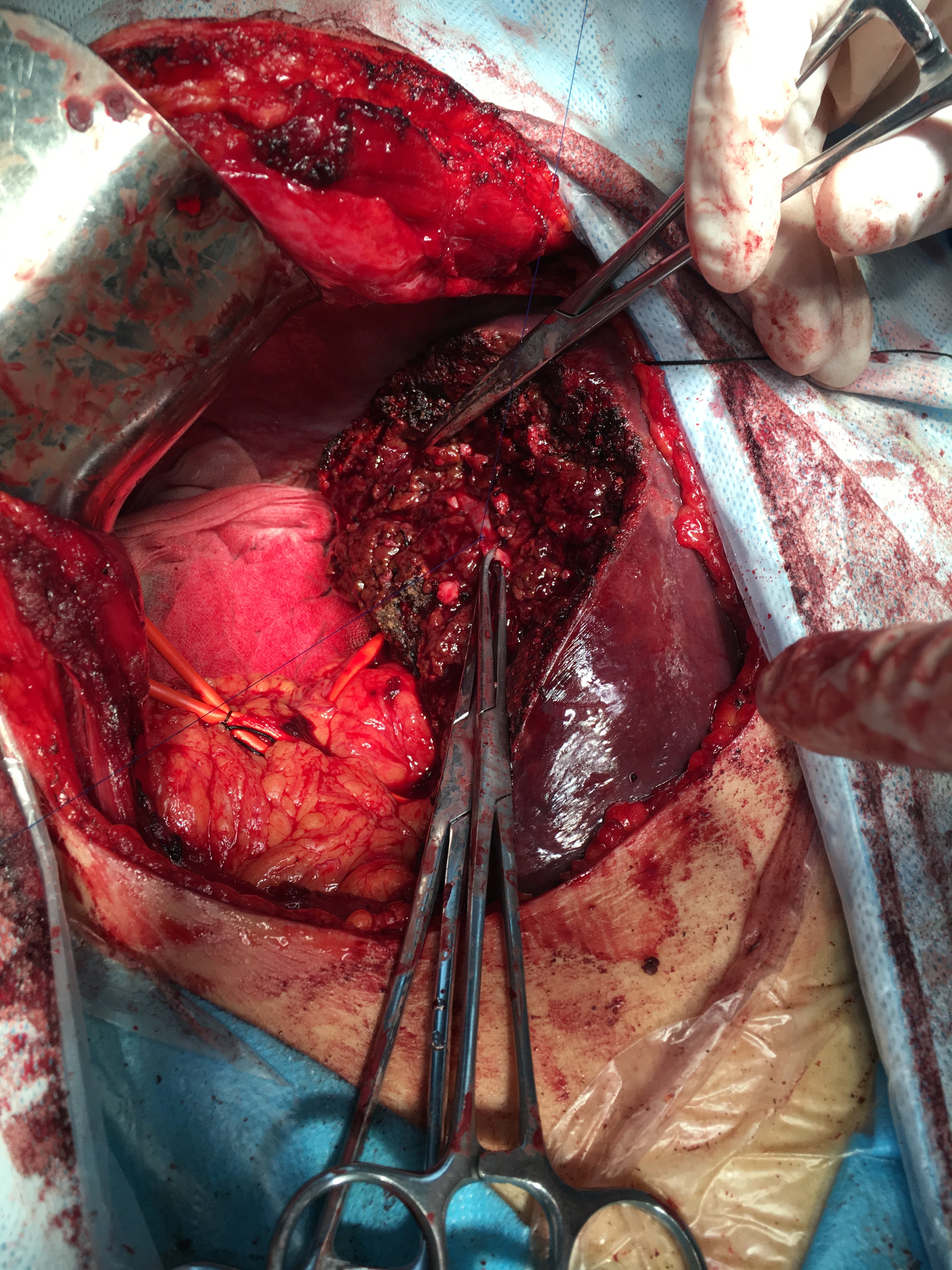 肝炎后肝硬化并肝癌的右后叶切除 - 好大夫在线