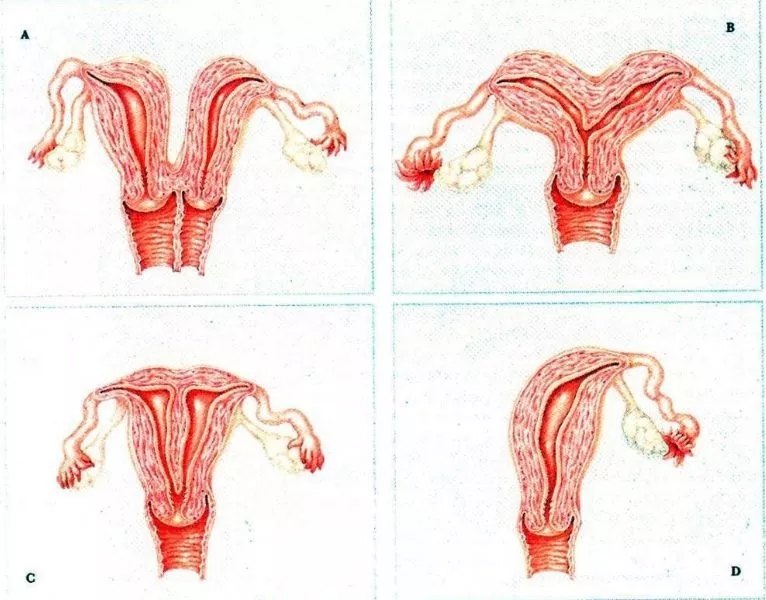 依据解剖学异常将子宫畸形分类:残角子宫,双子宫,双角子宫,纵隔子宫