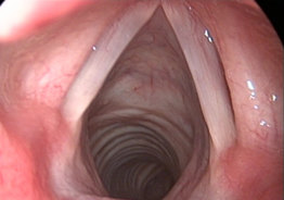 咽喉后壁白斑图片高清图片