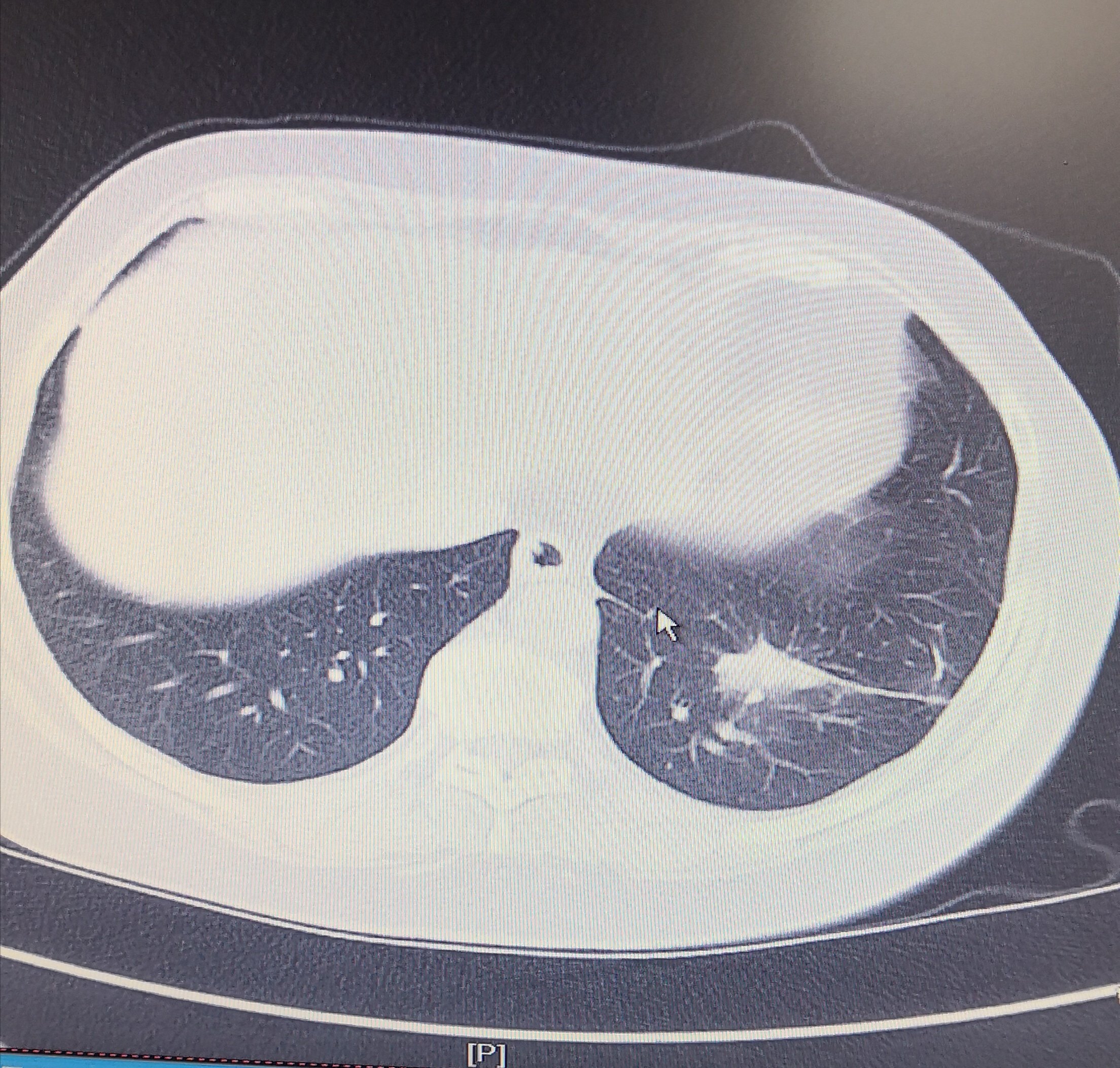 哈医大二院胸外科经典病例之肺癌患者颈部淋巴结交叉转移 