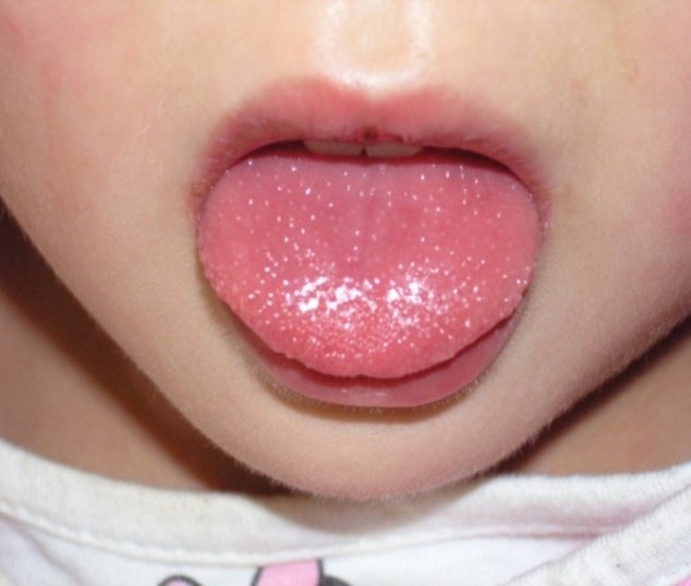 宝宝舌苔霉菌感染图片图片