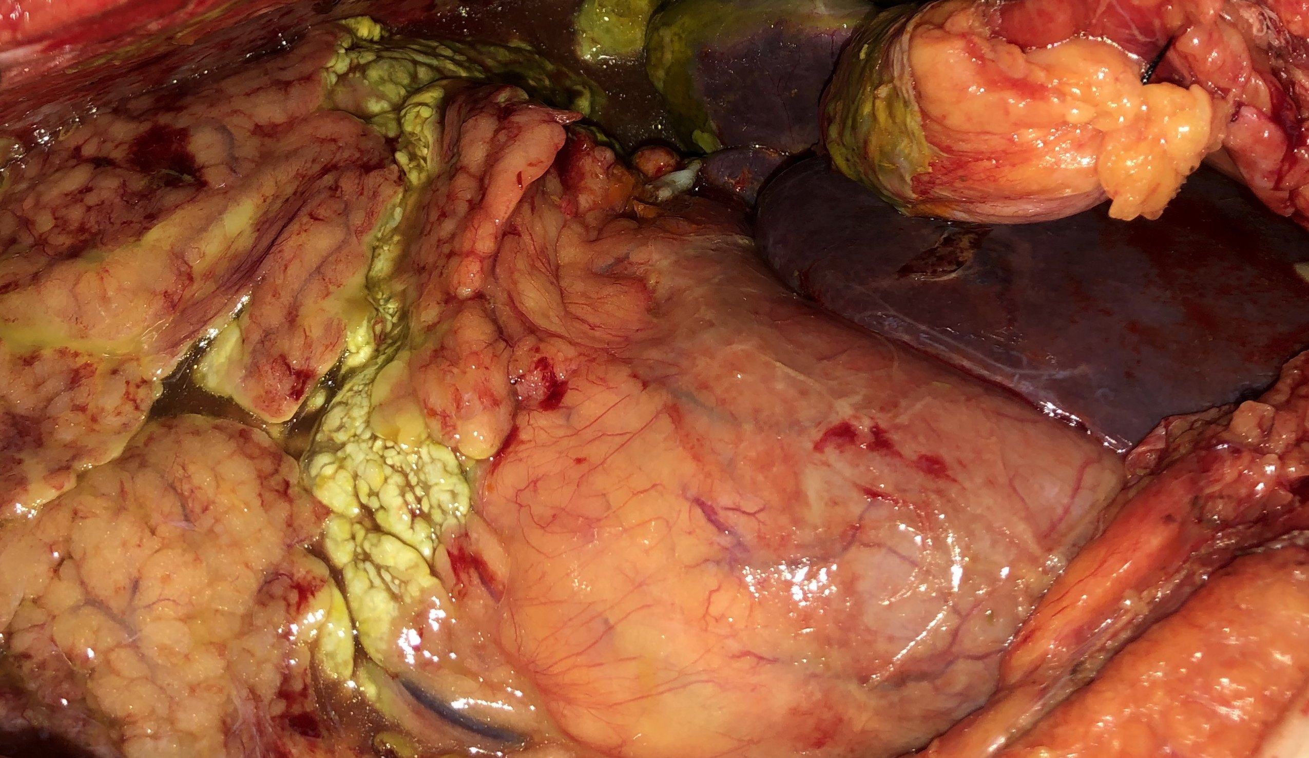 每周诊疗笔记之十二指肠瘘伴腹腔内感染,脓毒症性休克的外科处理 - 好