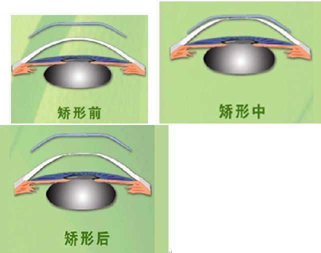 塑形镜的原理_△角膜塑形镜视力矫正原理(2)