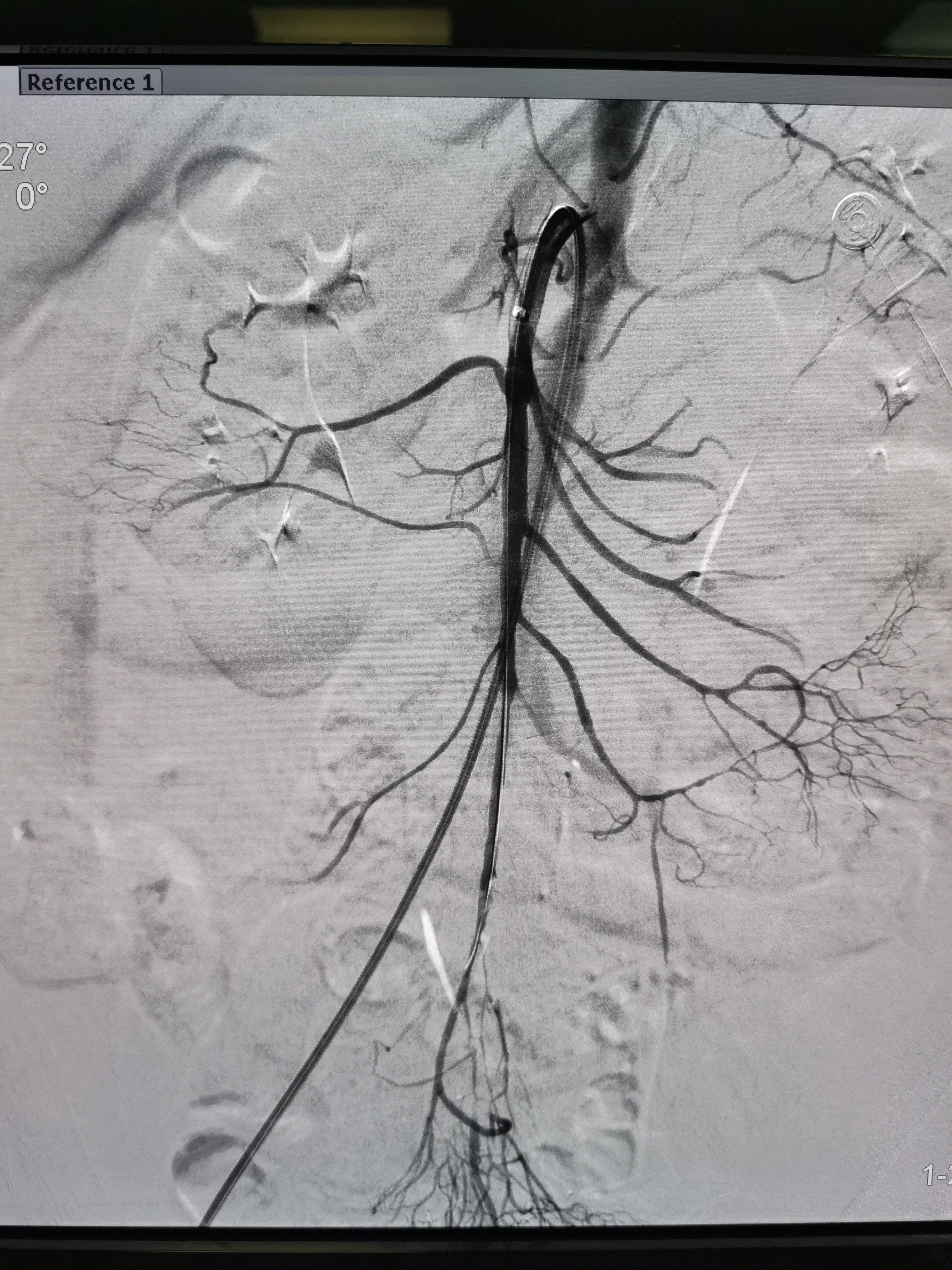 微创治疗急性肠系膜上动脉栓塞 - 好大夫在线