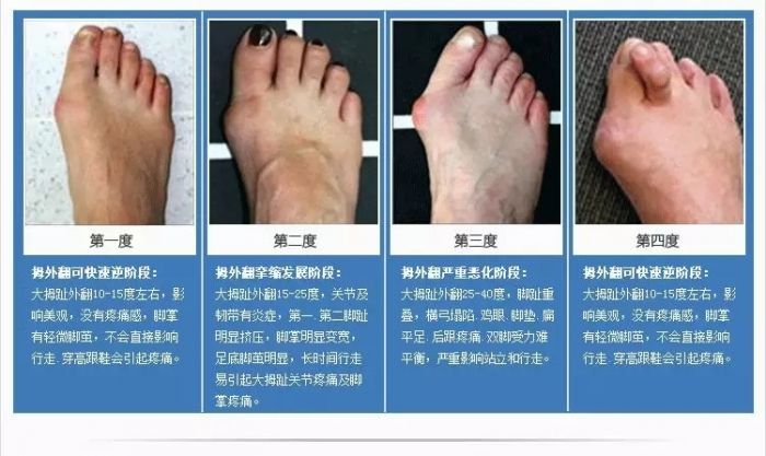 拇外翻怎么治疗 拇外翻 疾病介绍 病因 治疗方法 手术 症状