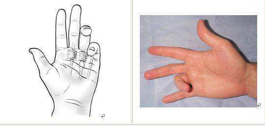 了解儿童先天性扳机指的治疗