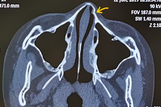 鼻骨骨折是拍x线平片还是ct呢 鼻骨骨折 鼻骨骨折检查