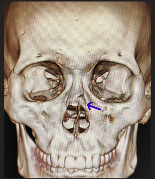 鼻骨骨折是拍x线平片还是ct呢 鼻骨骨折 鼻骨骨折检查