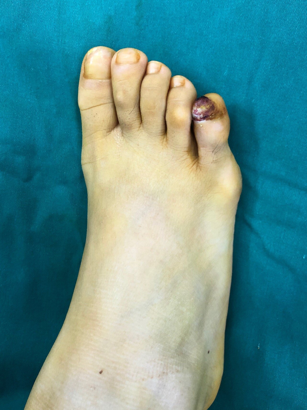 足部恶性肿瘤图片