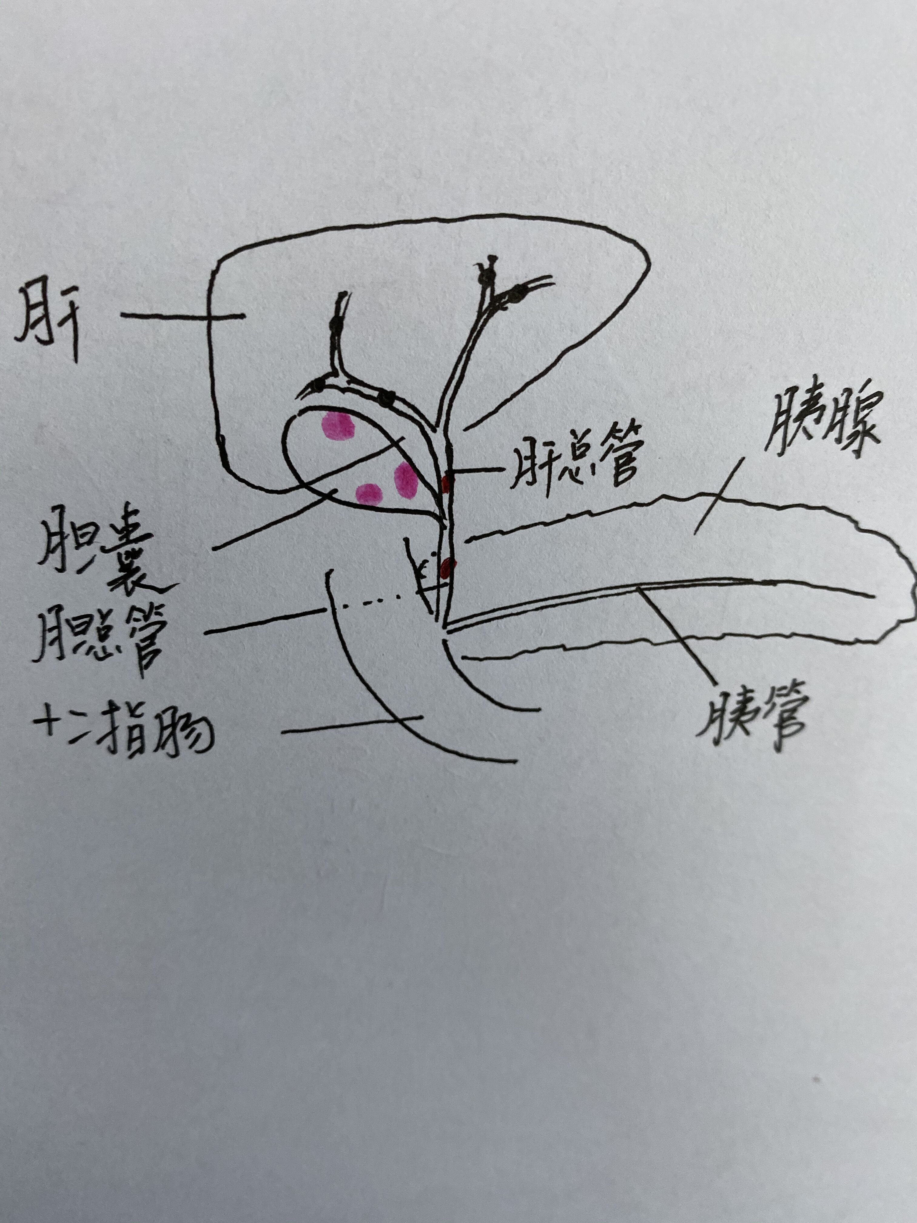 的胆管结石一,急性胆管炎结石堵塞于肝外胆管内,可引起胆汁引流不畅
