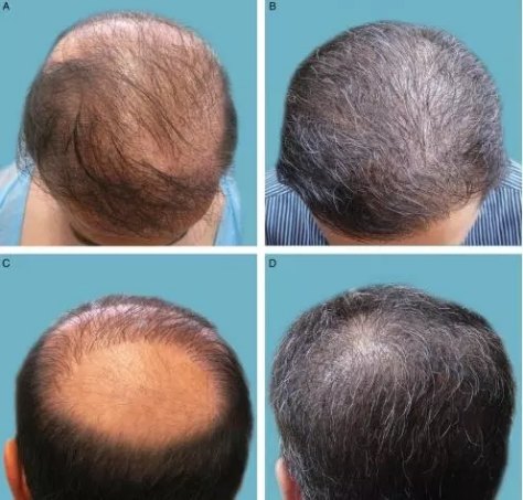 雄激素性脱发的治疗方法