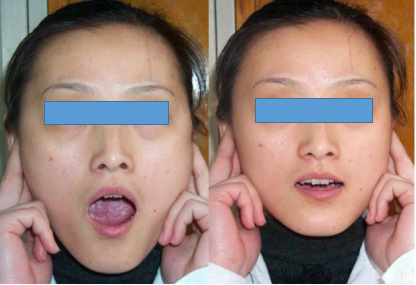 颞下颌关节紊乱病(tmd)的家庭保养(中)——治疗性锻炼_颞下颌关节紊乱