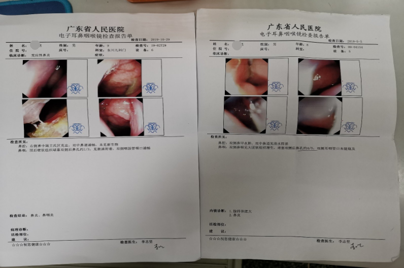 鼻腺樣體增生非手術治療效果怎樣?