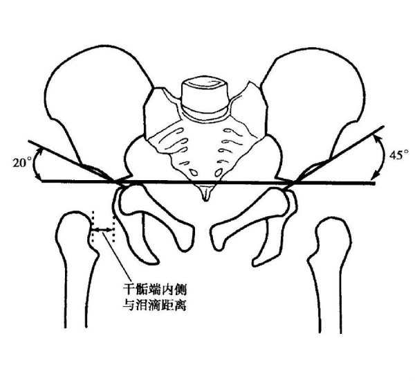 治疗黄金期切勿错过_先天性髋关节脱位_先天性髋关节脱位治疗方式
