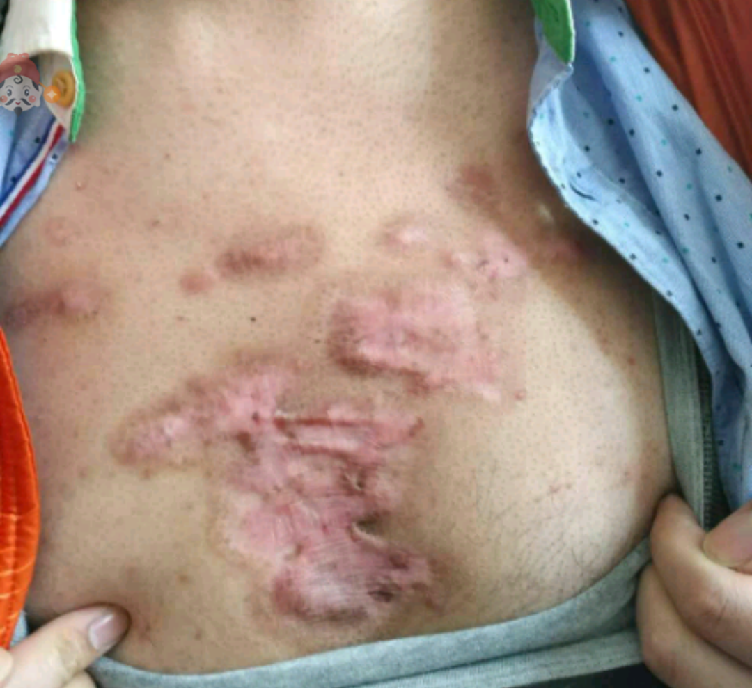 下巴两侧长痤疮怎么办_下巴痤疮怎么治疗_下巴一直长痤疮怎么回事?