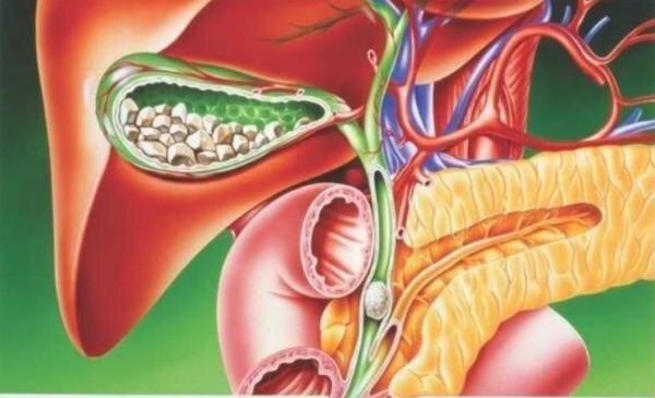 老年人急性胆囊炎该如何治疗