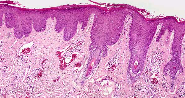 疯狂的毛细血管(一)——鲜红斑痣组织病理学特点解析 - 好大夫在线