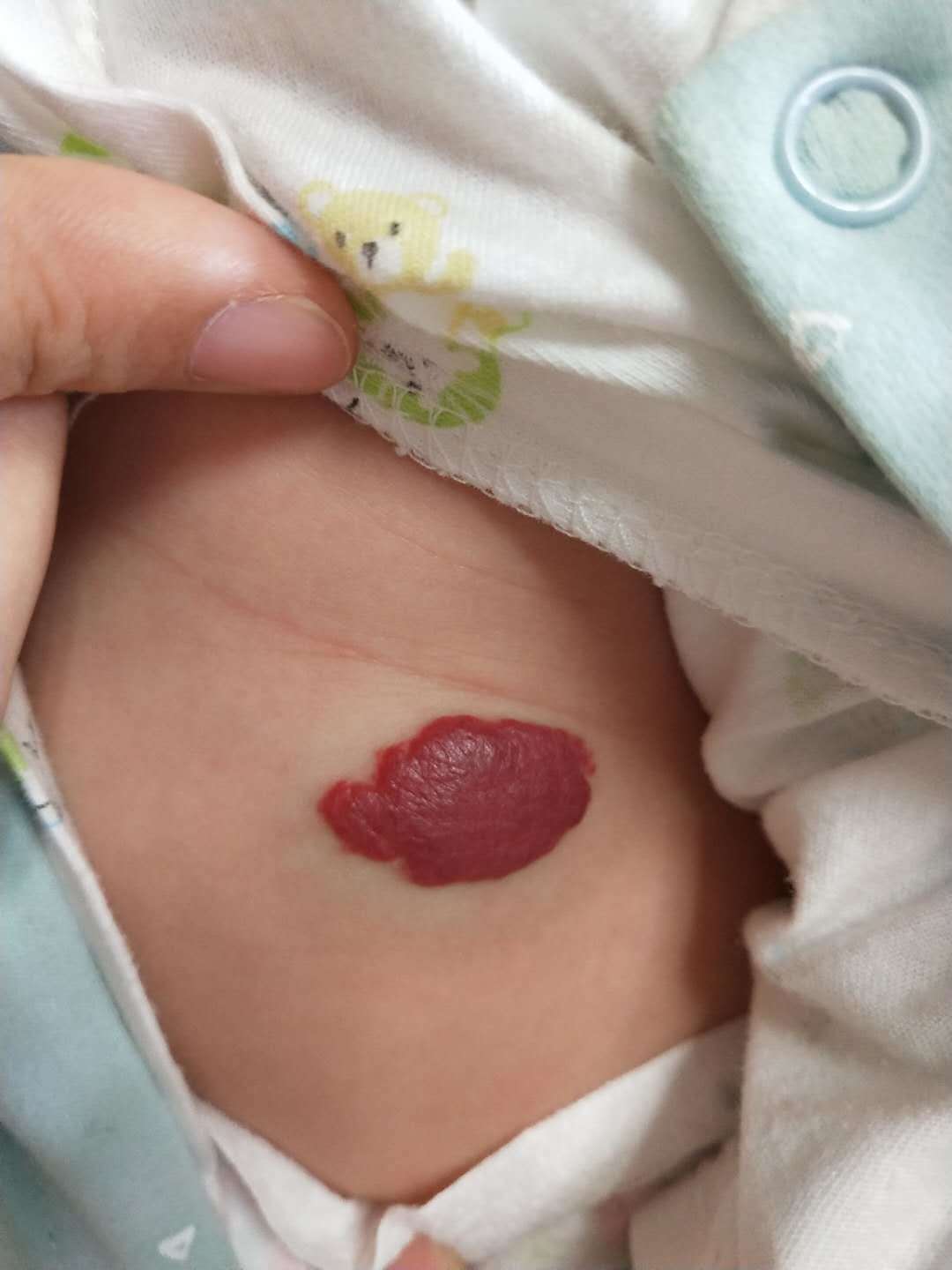 婴幼儿血管瘤_介绍_发病原因_症状表现_治疗方式 - 好大夫在线