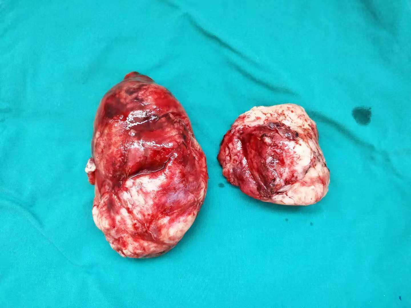 5厘米恶性孤立性纤维肿瘤是极为罕见的恶性肿瘤, 国内外文献报道极少