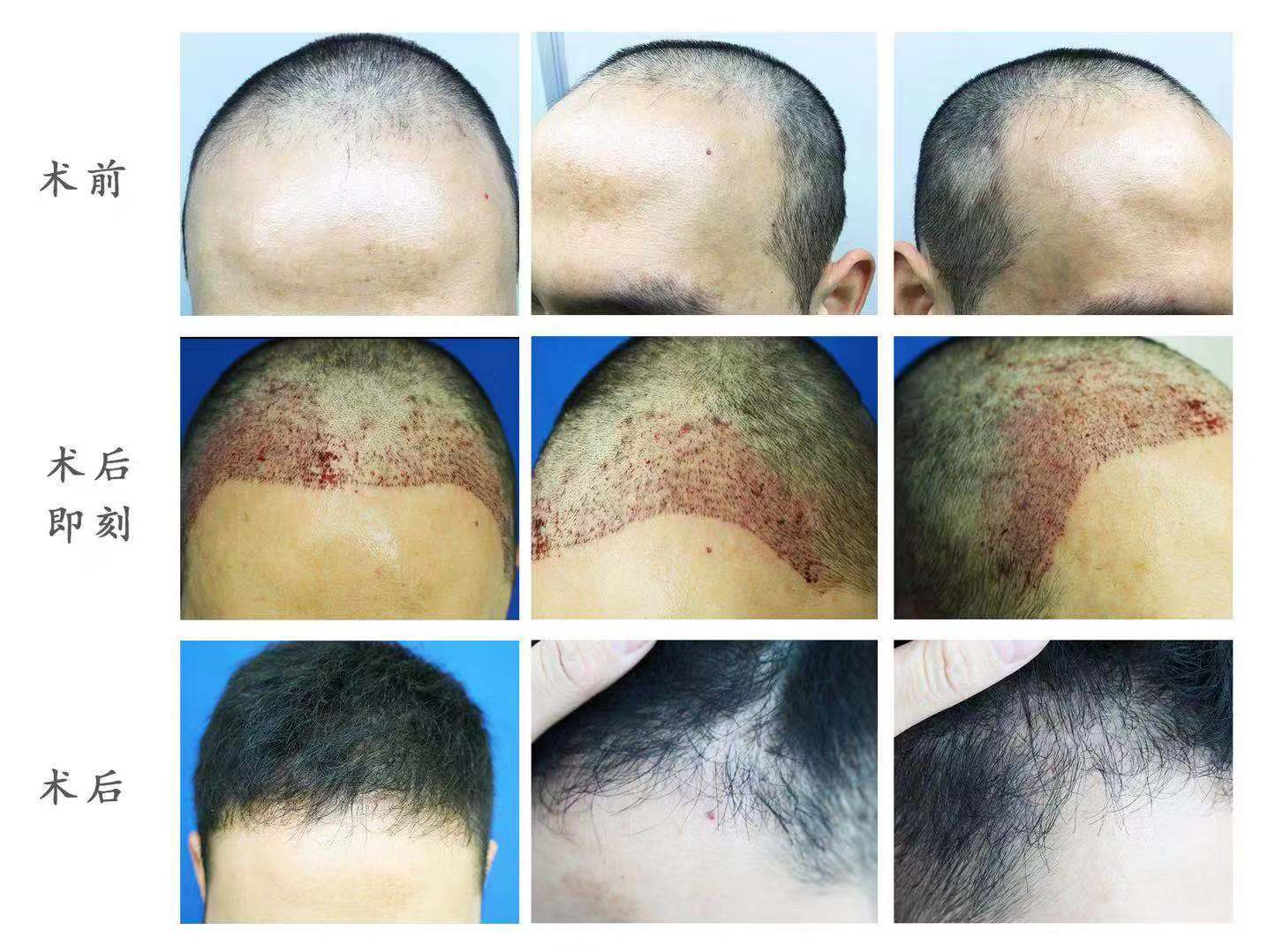 fue毛发移植术不仅仅专治各种秃头,对于头发稀疏,发际线后移,瘢痕性