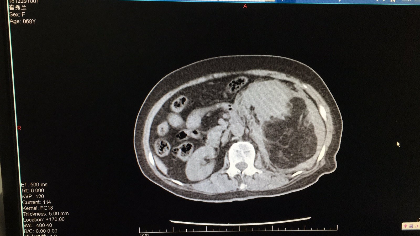 肾构瘤图片