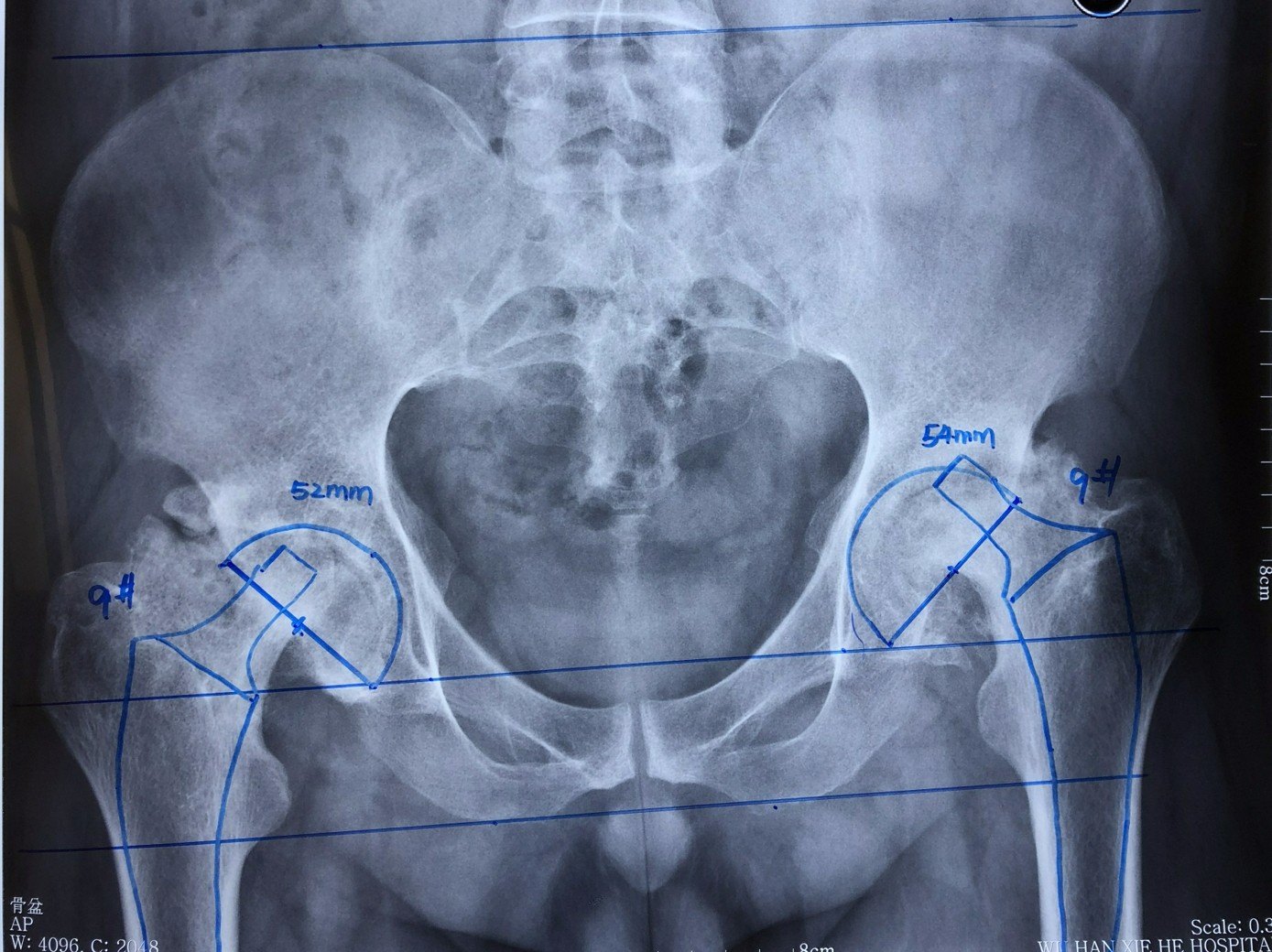 葉教授的關節日誌1年輕的小帥哥雙側股骨頭壞死