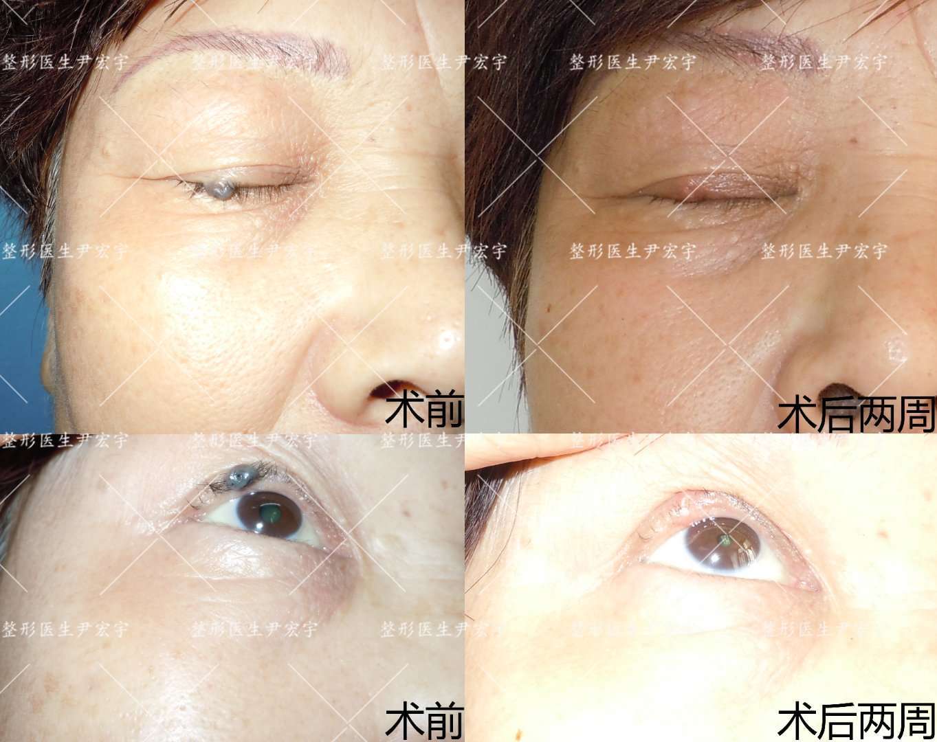 痣切除案例分析 工作日志 - 好大夫在线