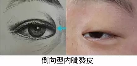 倒向型较少见,主要在"小睑裂综合征"中出现,需进行复杂的综合矫正手术