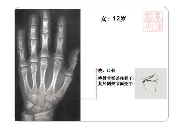 骨齡圖譜身高測試