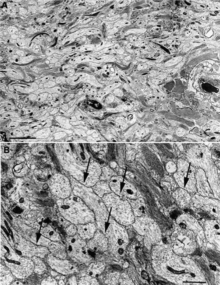 图a,电子显微照片显示多发性硬化症患者神经根慢性脱髓鞘(比例尺10μm