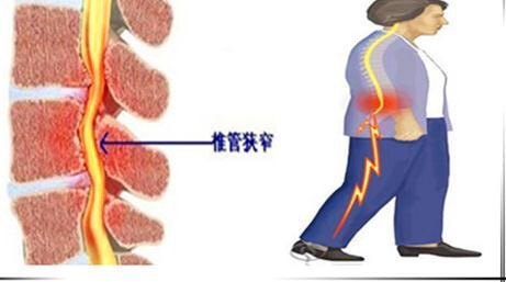 腰椎病為什麼會引起腿疼