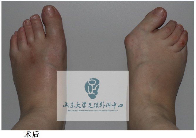 类风湿性关节炎足部畸形的治疗 - 好大夫在线