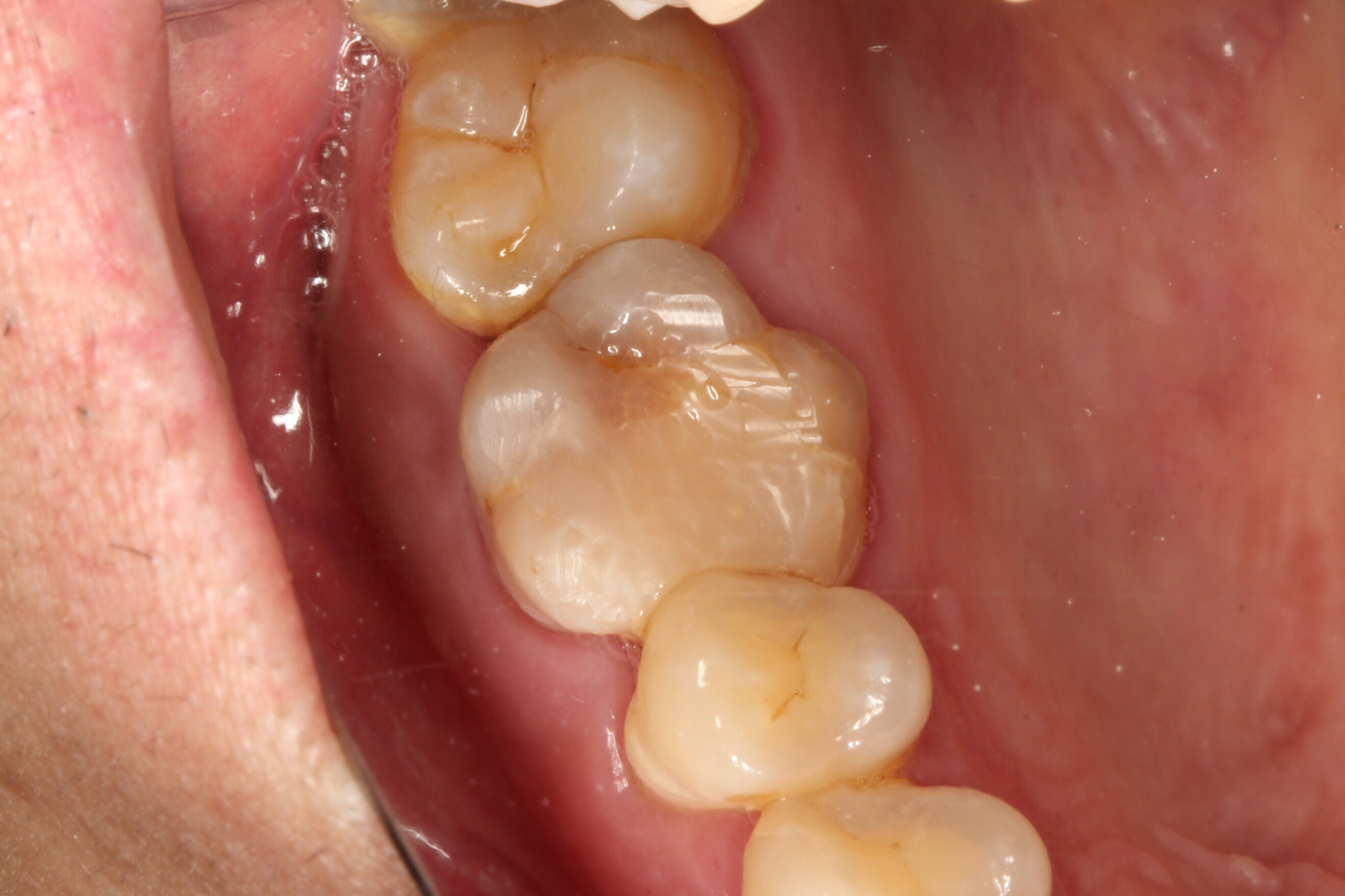 这就是牙根治疗的复杂性,很强烈的技术性,治疗牙根不是简简单单,补